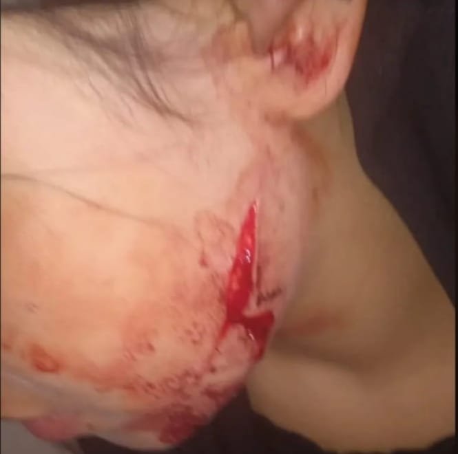 تلميذ يشوه وجه زميلته بـ12 غرزة بضواحي اليوسفية